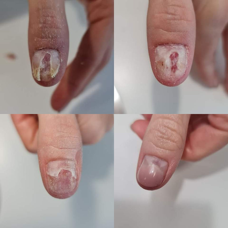 Lūžinėjantys nagai